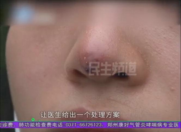 朋友说我是一只米老鼠郑州一女子在幻颜整形医院整鼻后鼻头发黑发紫