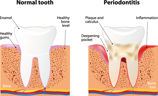 植得口腔医生提醒：警惕牙周病——牙齿的“沉默杀手”！